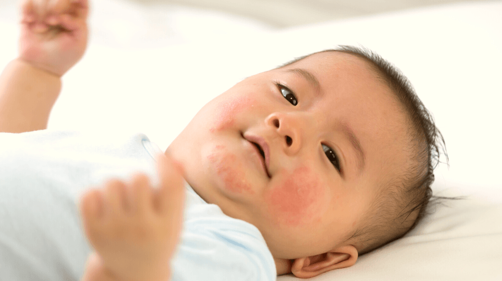 Baby eczema - innobaby