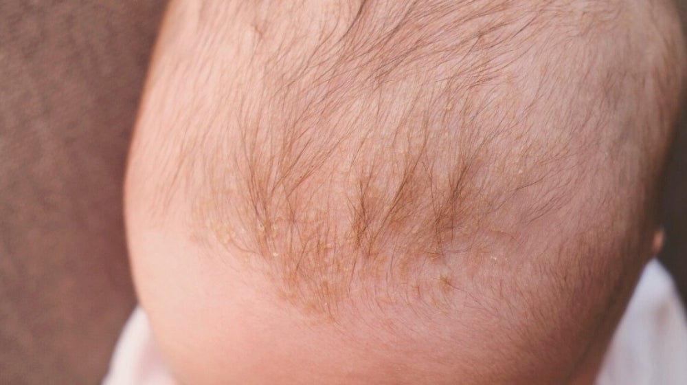 How to Treat Infant Cradle Cap at Home - innobaby